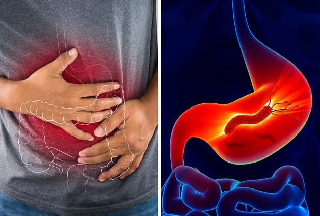 Giải đáp vi khuẩn HP là gì