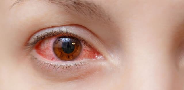 Tìm hiểu về bệnh viêm kết giác mạc mắt