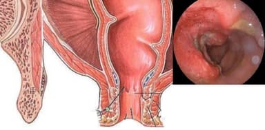 Viêm trực tràng có nguy hiểm không? Cách điều trị bệnh