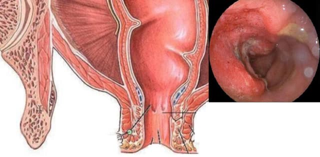 Viêm trực tràng có nguy hiểm không? Cách điều trị bệnh