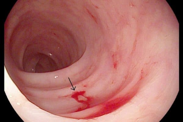 Xuất huyết tiêu hóa khi bị đau dạ dày