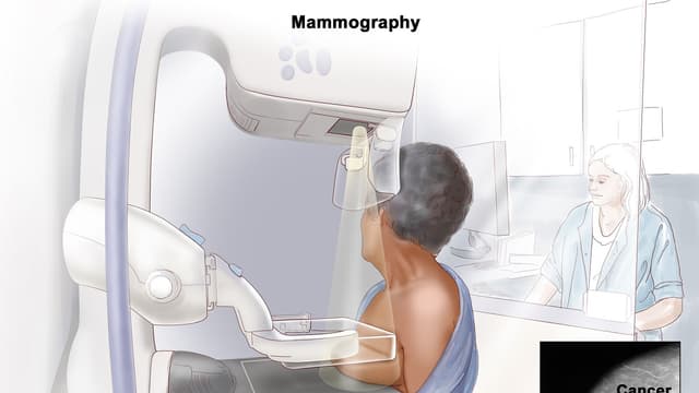 Xét nghiệm ung thư vú quan trọng đến mức nào với phụ nữ?