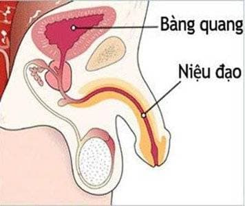phẫu thuật lấy sỏi bàng quang 