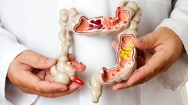 bệnh Crohn ở trẻ em là gì