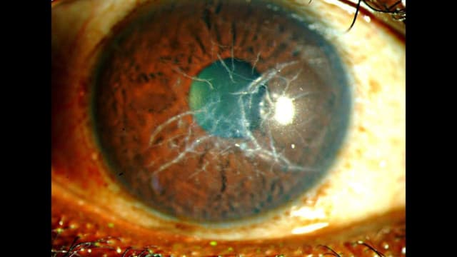 Bệnh loạn dưỡng giác mạc: Hiếm nhưng rất nguy hiểm