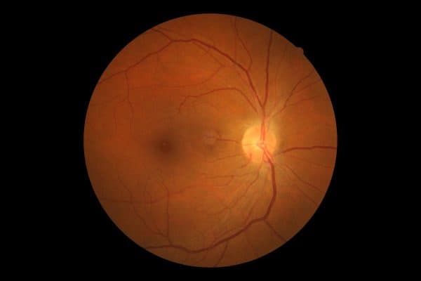 Võng mạc tăng huyết áp do bị ảnh hưởng của bệnh cao huyết áp