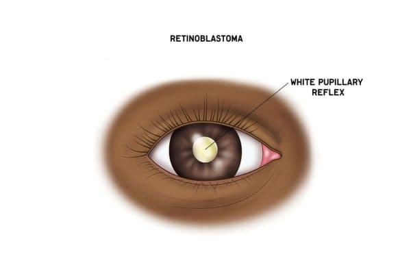 Ung thư võng mạc thường gặp ở trẻ nhỏ với biểu hiện là ánh đồng tử trắng
