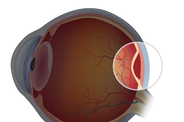 Võng mạc là màng bên trong đáy mắt, có nhiệm vụ tiếp nhận ánh sáng từ thủy tinh thể