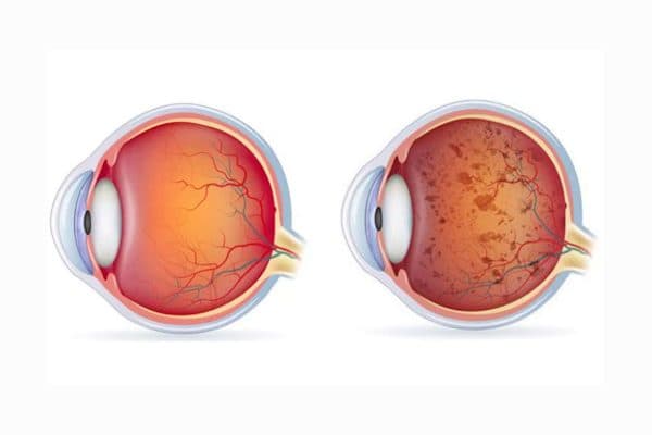 Bệnh viêm võng mạc sắc tố là tập hợp các bệnh phá hủy các tế bào que trong võng mạc