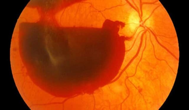 Bệnh xuất huyết dịch kính: Tiềm ẩn nguy cơ mù lòa vĩnh viễn