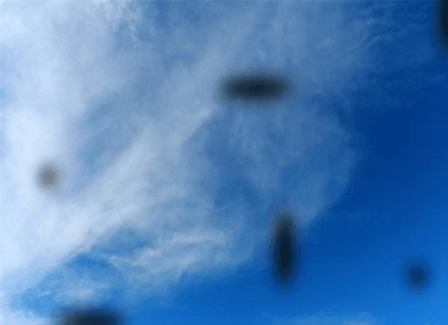 Nhìn thấy ruồi bay trong tầm mắt là dấu hiệu xuất huyết dịch kính