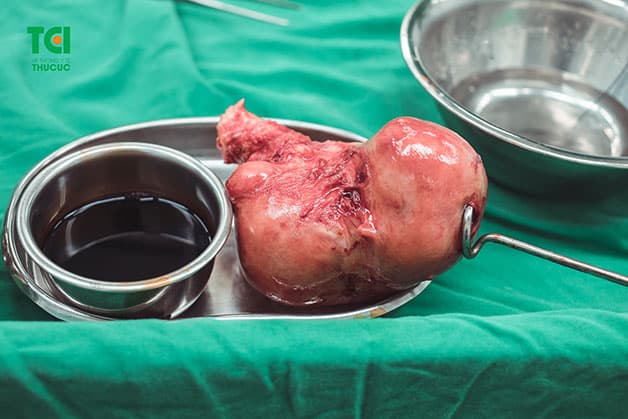 Bị rong kinh có nguy hiểm không? Rong kinh có thể là biểu hiện của một số bệnh phụ khoa nghiêm trọng