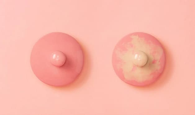 Tắc tia sữa có mủ cho thấy tình trạng tắc tia sữa đã trở nên nghiêm trọng hơn