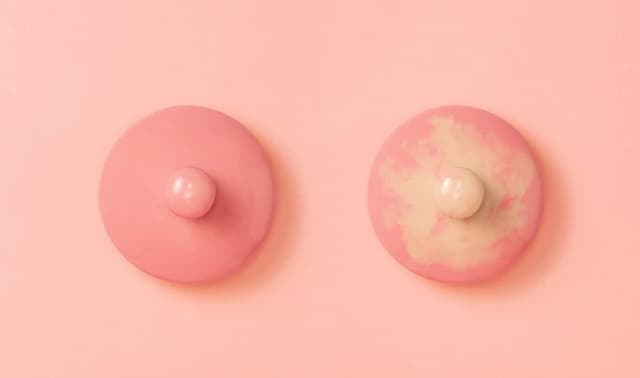 Mẹ sau sinh bị tắc tia sữa có mủ, cần làm gì?