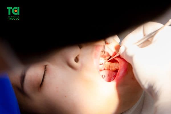 bị viêm lợi trùm