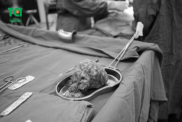 U xơ tử cung ngày càng có xu hướng trẻ hóa và dễ phát triển, để lại biến chứng