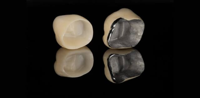 Bọc răng sứ bán phần là gì, có nên thực hiện không?