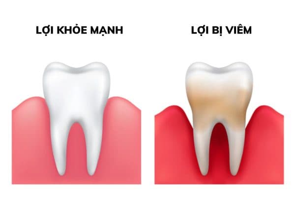 Viêm lợi là tình trạng tổn thương các tổ chức mô mềm quanh răng do vi khuẩn gây ra