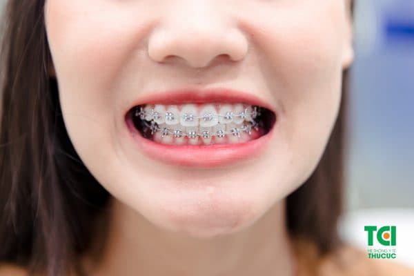chăm sóc răng khi niềng