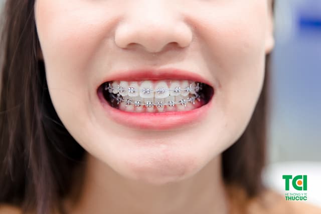 Chăm sóc răng khi niềng thế nào? Cần chú ý điều gì?