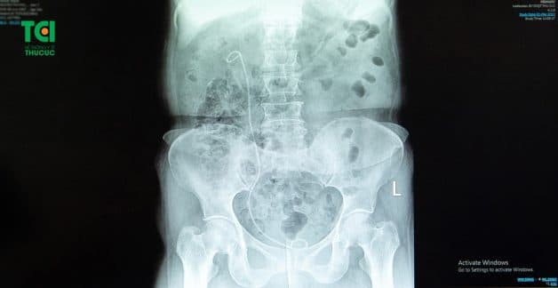 Đối tượng chỉ định đặt sonde JJ và chống chỉ định đặt sonde JJ