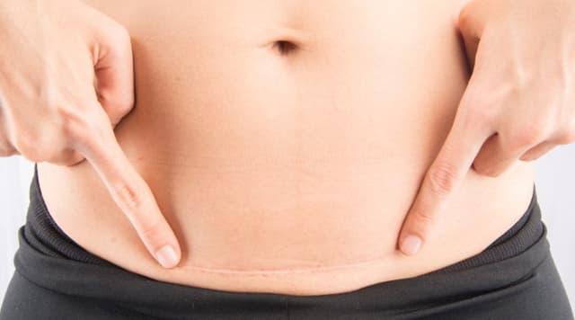 Đẻ mổ bị đau bụng bao lâu mới hết?