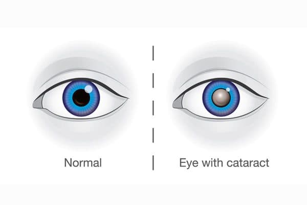 Thấu kính không còn trong suốt khiến cho thị lực bị giảm mạnh được các chuyên gia gọi là đục thủy tinh thể