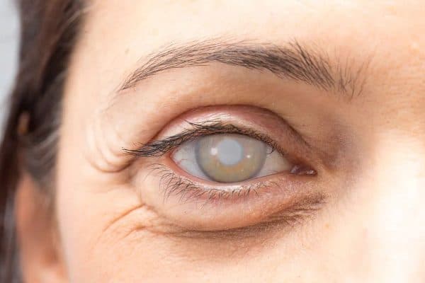 Đục thủy tinh thể dấu hiệu nhận biết thường là mắt nhìn mờ, thuỷ tinh thể mất đi độ trong, mắt nhạy cảm với ánh sáng...