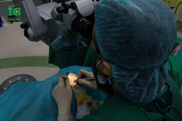 Theo đó, mổ Phaco Oertli được áp dụng