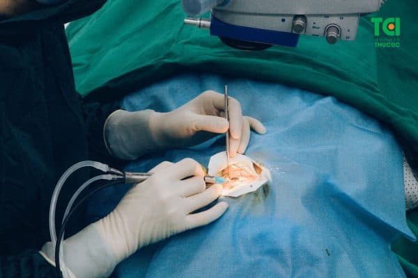 giá mổ mắt đục thủy tinh thể
