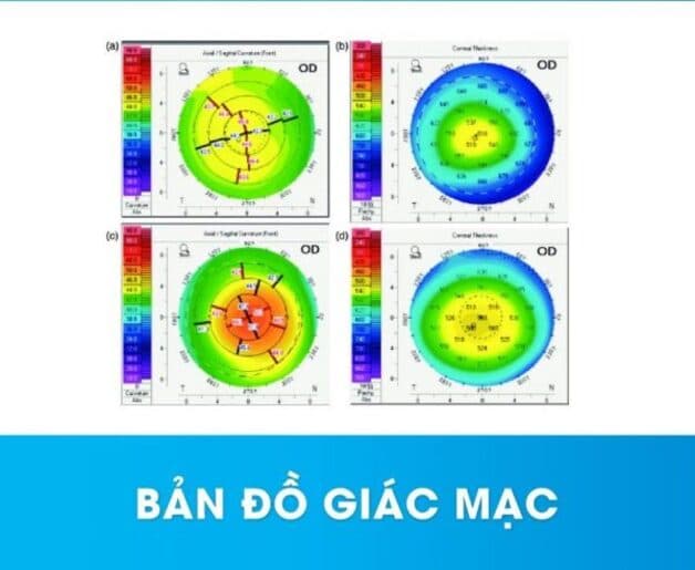 giác mạc mỏng