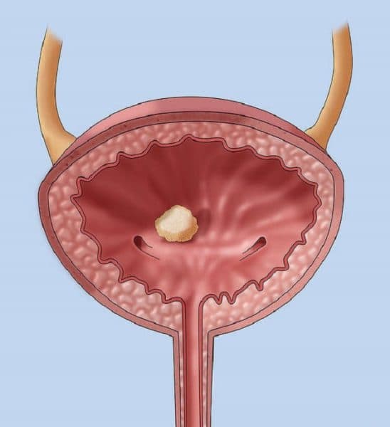 Dấu hiệu của sỏi bàng quang trong hệ tiết niệu