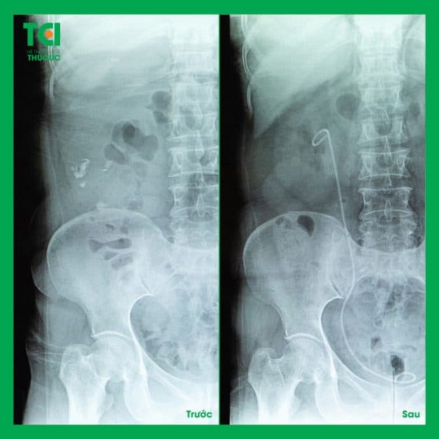 Những lưu ý trước và sau tán sỏi nội soi ngược dòng bằng laser