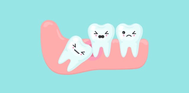 Giải đáp: Khi nào nên nhổ răng khôn mọc lệch?