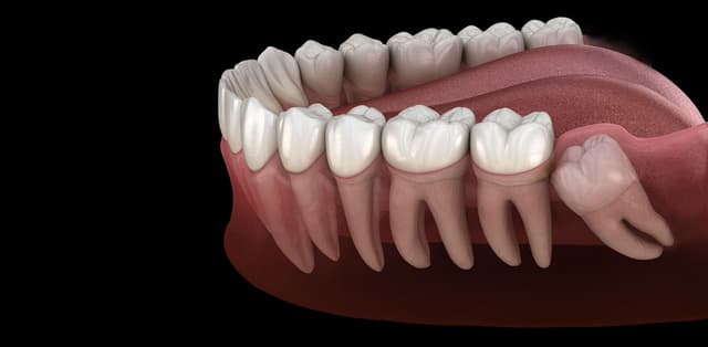 Giải đáp: Khi nào nên nhổ răng khôn mọc ngầm?