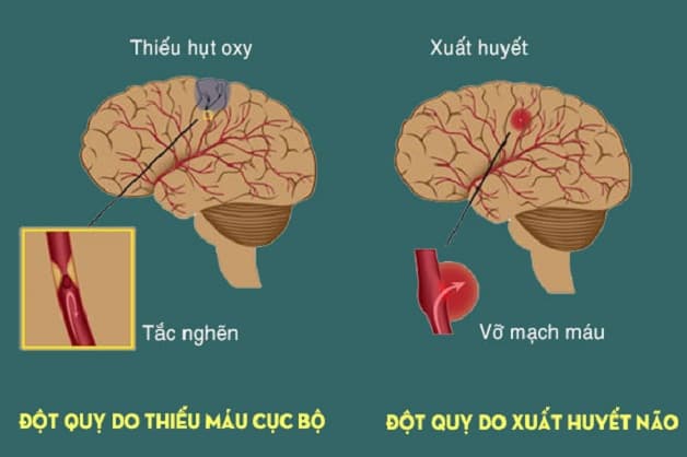 khó ngủ đau đầu tăng nguy cơ đột quỵ
