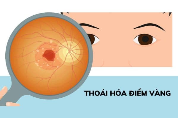 Thoái hóa điểm vàng, đục bao sau... là những nguyên nhân khiến mắt nhìn mờ sau mổ Phaco