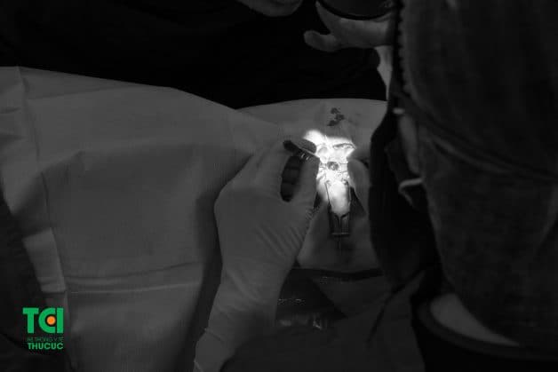 Mổ phaco mắt ít đau đớn