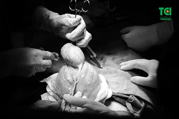 Những trường hợp có khối u kích thước lớn cần can thiệp phẫu thuật, chị em sẽ thắc mắc mổ u xơ tử cung kiêng quan hệ bao lâu