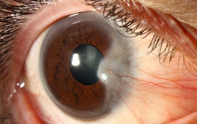 Mộng thịt là bệnh gì? Mộng thịt độ 3: Mộng thịt bao phủ hoàn toàn đồng tử.