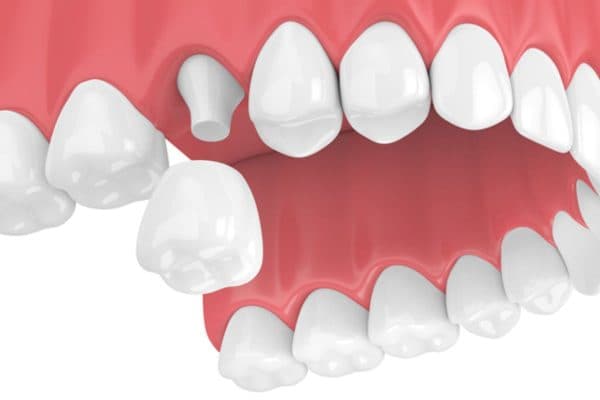 Kết hợp phẫu thuật và bọc sứ để cải thiện tình trạng hàm hô