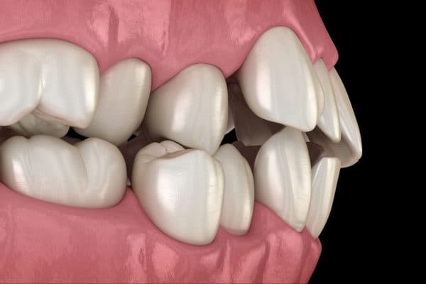 Hô là sự mất cân xứng giữa hai hàm khiến hàm trên bị nhô ra quá mức so với hàm dưới