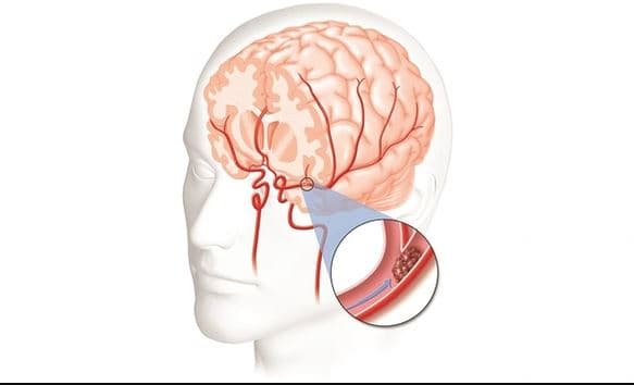 cục máu đông là một nguyên nhân gây tai biến mạch máu não