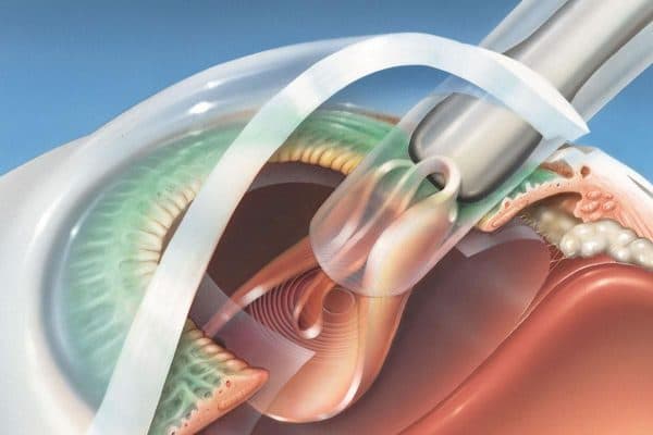 Phẫu thuật Phaco tán nhuyễn và hút thủy tinh thể đục ra ngoài, thay bằng thủy tinh thể nhân tạo