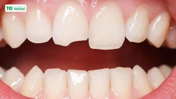 phục hình răng mẻ