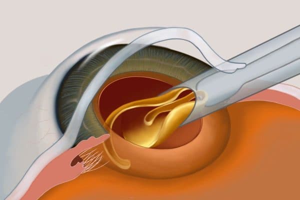 Phẫu thuật Phaco tán nhuyễn thủy tinh thể bị đục và thay thế bằng thủy tinh thể nhân tạo để khôi phục thị lực