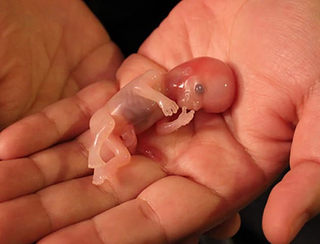 Hiện tượng sảy thai thường diễn ra ở các tuần thai sớm, trước tuần 20