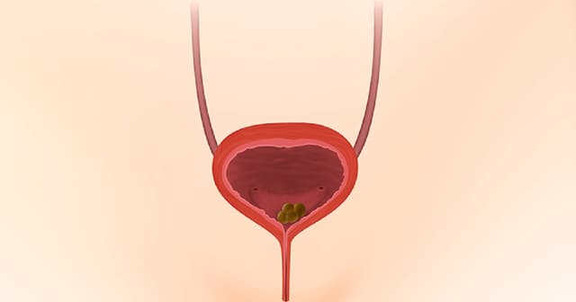 Sỏi bàng quang 7mm có nguy hiểm không và cách điều trị