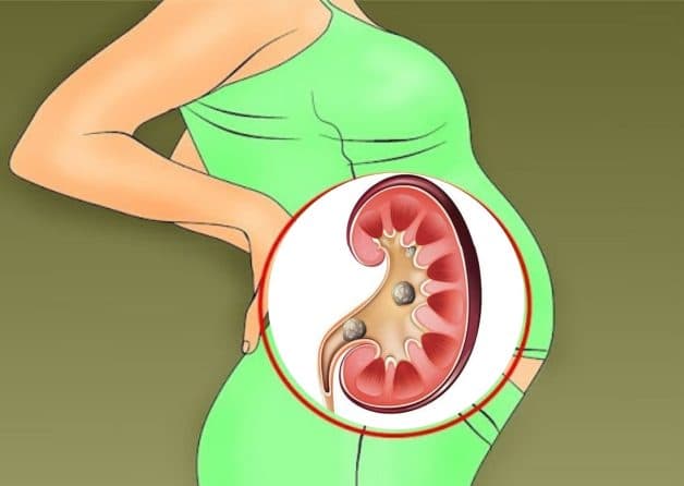 Giải đáp tán sỏi ngoài cơ thể có hại không, có ảnh hưởng gì không