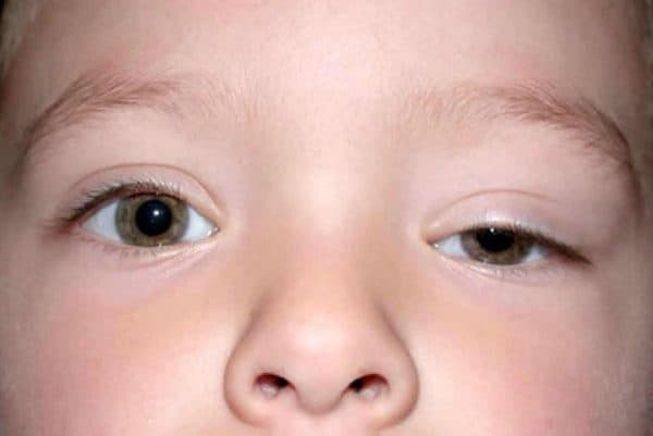 sụp mí bẩm sinh